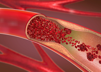 A 3d illustration of a constricted and narrowed artery and the blood cannot flow properly called arteriosclerosis