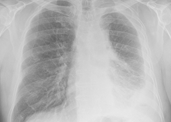 An x-ray of lungs