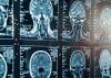 Doctor shows MRI Brain Scan of head and skull.