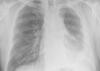 An x-ray of lungs